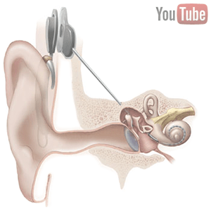 cochlear implant