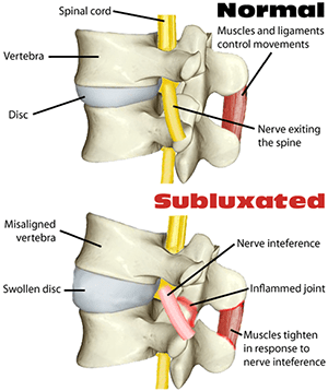 Subluxation