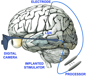 visual prosthesis