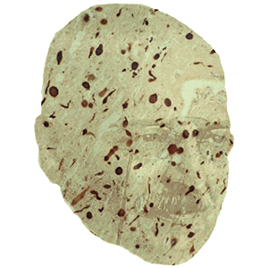 Alois Alzheimer by Nicholas Wade