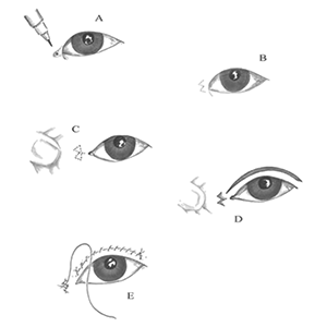Blepharoplasty